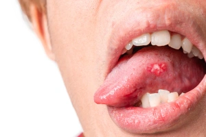 Tooth with large cavity