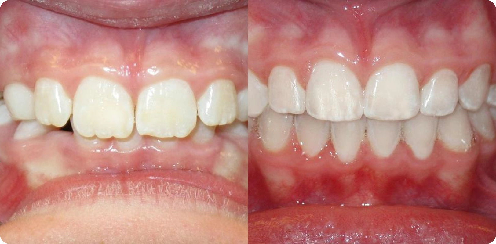 Neha Joshi Before and After