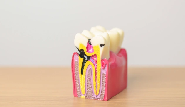 Root Canal Treatment Diagram