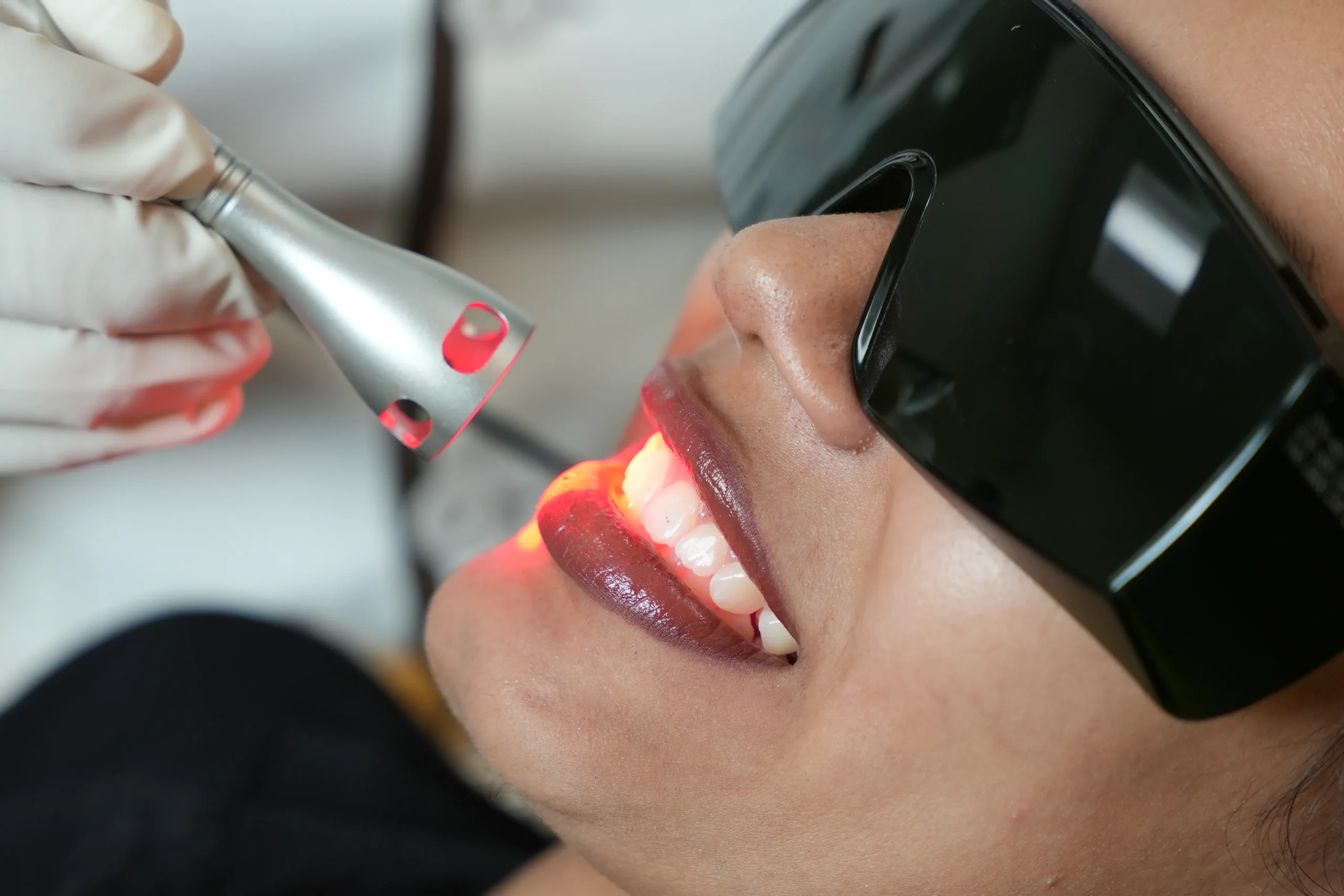 Gummy smile treatment