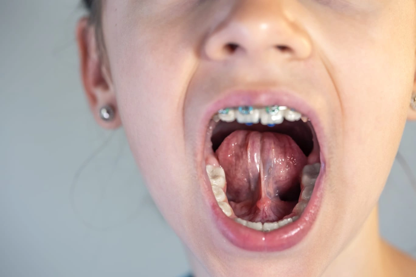 Treating tongue frenulum