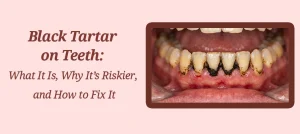 Black Tartar on Teeth: What It Is, Why It’s Riskier, and How to Fix It