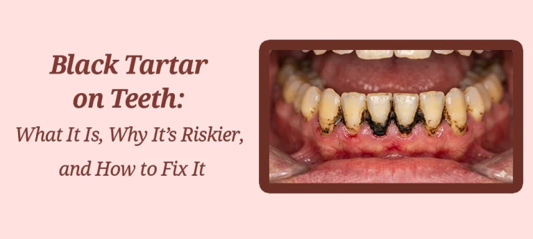 Black Tartar on Teeth, What It Is, Why It’s Riskier, and How to Fix It